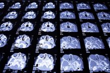 Artificial intelligence (AI) software can analyze medical images, and the practice will  become increasingly common, helping radiologists detect anomalies, diagnose disease, monitor cancer, and offer better prognoses.