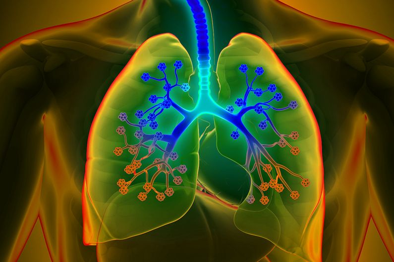 La fibrose kystique touche principalement les poumons.