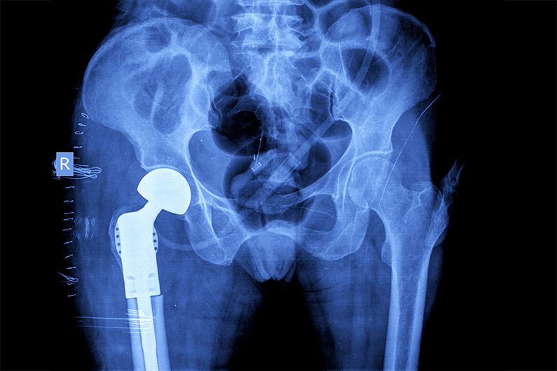 Au cours des cinq dernières années, le nombre d’arthroplasties de la hanche et du genou effectuées au Canada a augmenté sans cesse. 