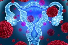 Les résultats d'une nouvelle étude ouvrent la voie à terme à la mise au point de nouvelles thérapies pour combattre l’un des cancers les plus fréquents et les plus dangereux chez la femme.