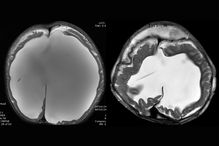A before-and-after view of the patient's skull shows how remarkably its size and cerebrospinal fluid was reduced by surgery.