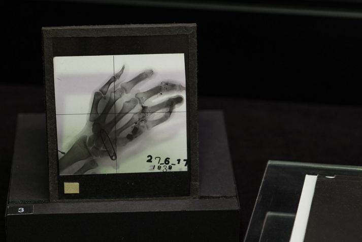 Radiographie de la main cassée du président français Raymond Poincaré
