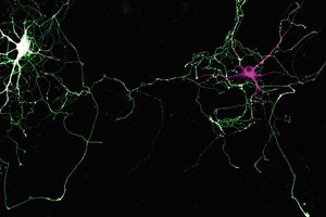 La maladie de Parkinson, l’une des affections neurodégénératives les plus fréquentes, touche un nombre grandissant de personnes dans la population vieillissante.