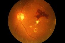 Diabetic retinopathy is caused by a degeneration of the small blood vessels that feed the retina and that regrow abnormally.