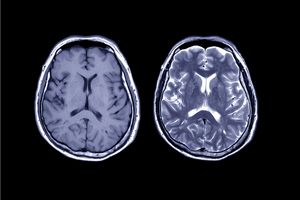 La leucodystrophie s'attaque à la matière blanche du cerveau, la myéline.