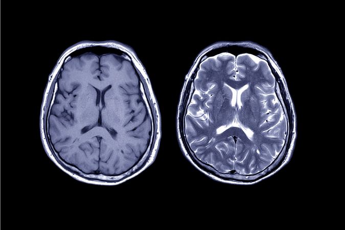 La leucodystrophie s'attaque à la matière blanche du cerveau, la myéline.