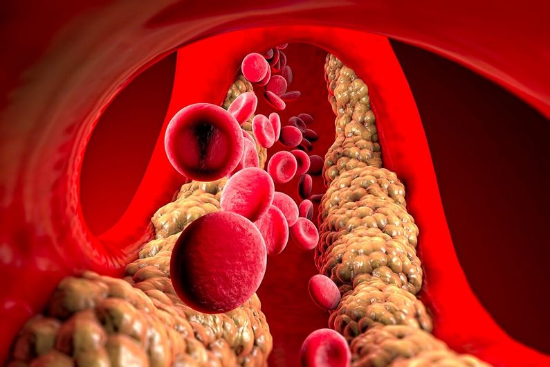 Les lipoprotéines de basse densité ou LDL (pour «low density lipoproteins») peuvent s'accumuler dans le sang et entraîner l'athérosclérose et des maladies cardiaques.