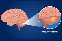 Medulloblastoma, an invasive form of cancer of the brain.