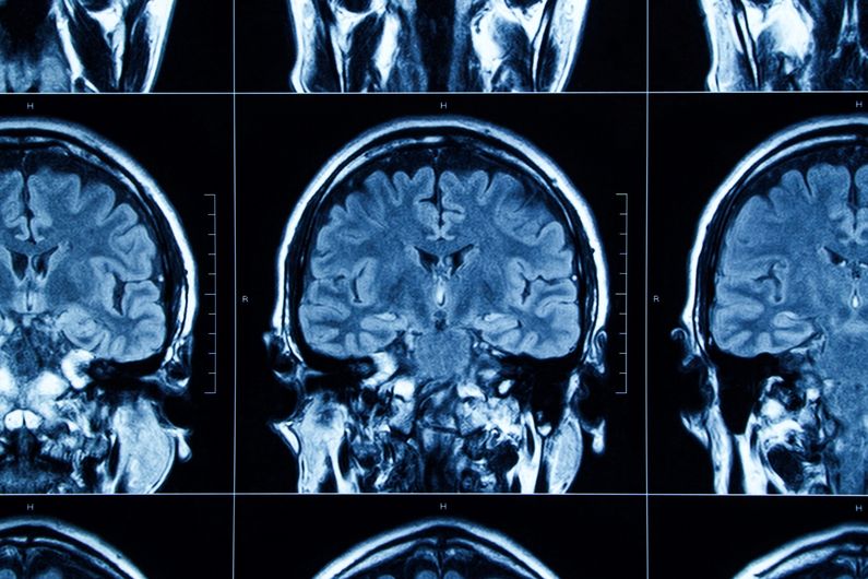Méconnue, la démence à corps de Lewy est la démence la plus fréquente dans la population après la maladie d’Alzheimer.