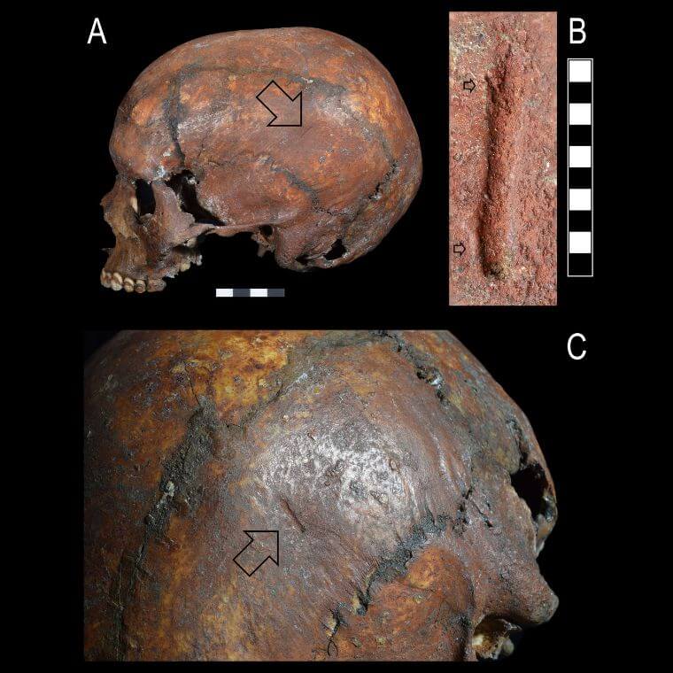 The linear groove in the left parietal. A: Left view of the cranium; the arrow indicates the position of the groove; scale in cm. B: magnification of the groove; scale in mm. The top arrow indicates the frayed appearance of one end of the groove, while the bottom arrow indicates the margin that show a plastic rounding of the cortical bone. C: Another view of the groove, indicated by the arrow, showing the intersecting vascular impression.