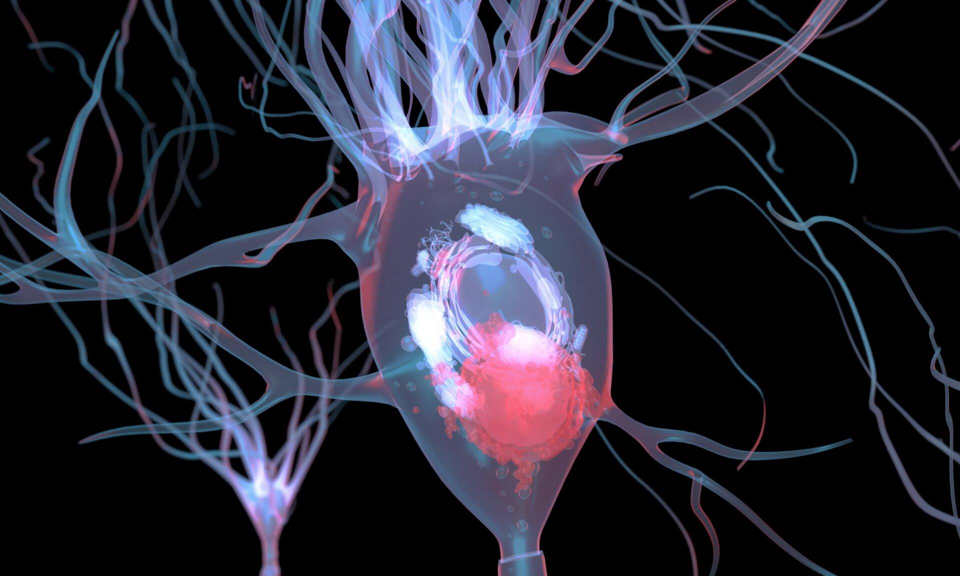 Neurone endommagé par un corps de Lewy, un amas anormal de protéines alpha-synucléine qui s'y accumulent.