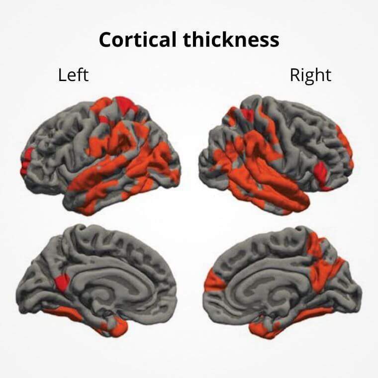 The regions in red correspond to those where there is a statistically significant thinning of the cerebral cortex.