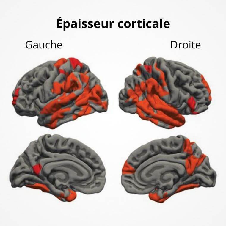 Les régions en rouge correspondent à celles où il y a un amincissement statistiquement significatif du cortex cérébral.