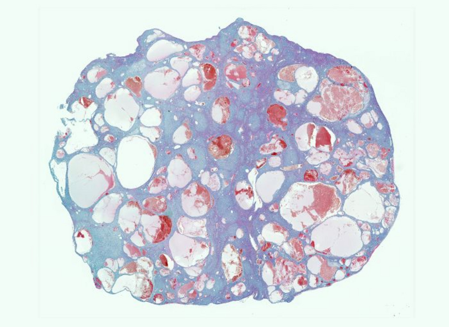 Œuvre scientifique nommée «Paysage lunaire», par Marjorie Lapouge. Coupe histologique d'un foie cancéreux. Cette œuvre est représentative des désordres et perturbations qui surviennent dans les organes atteints de cancer.