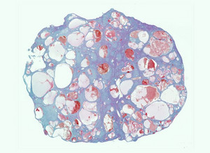 Création scientifique nommée «Paysage lunaire», par Marjorie Lapouge. Coupe histologique d'un foie cancéreux. Cette création est représentative des désordres et perturbations qui surviennent dans les organes atteints de cancer. Œuvre scientifique nommée «Paysage lunaire», par Marjorie Lapouge. Coupe histologique d'un foie cancéreux. Cette œuvre est représentative des désordres et perturbations qui surviennent dans les organes atteints de cancer.