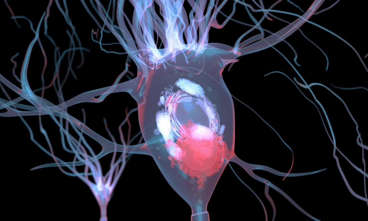 Neurone endommagé par un corps de Lewy, un amas anormal de protéines alpha-synucléine qui s'y accumulent.