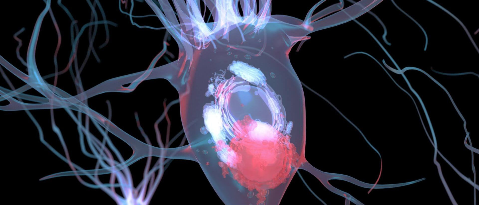 Neurone endommagé par un corps de Lewy, un amas anormal de protéines alpha-synucléine qui s'y accumulent.