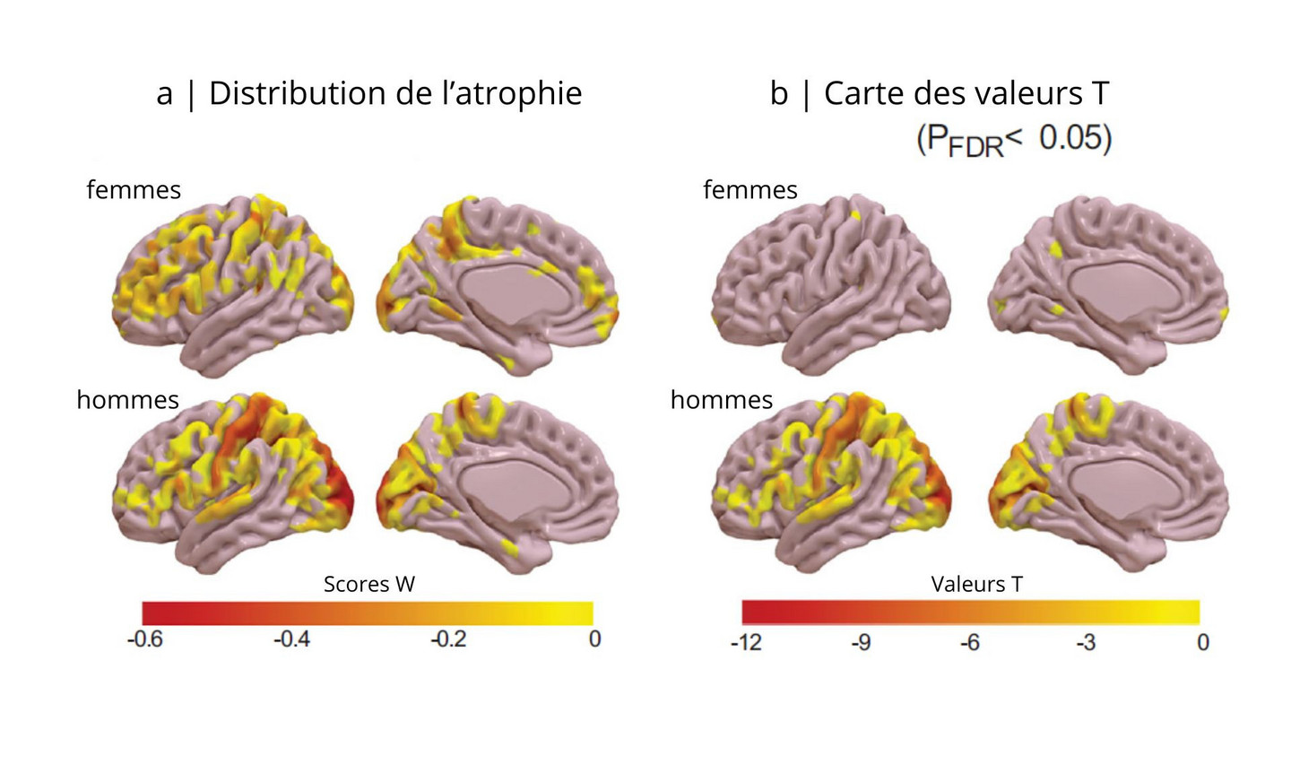 [Translate to English:] Sur l’image A, on compare l’épaisseur du cortex cérébral chez les femmes et les hommes atteints d’iRBD (trouble comportemental en sommeil paradoxal isolé) à celle attendue pour leur âge et leur sexe. Les couleurs indiquent à quel point certaines régions du cerveau sont plus minces que la normale. Plus la couleur est intense, plus la différence est marquée. Sur l’image B, on identifie les régions du cerveau où l’atrophie est statistiquement significative chez les femmes et les hommes. Cela signifie que ces zones sont vraiment affectées par la maladie, et pas juste par hasard. Les couleurs ici montrent la force de cette différence, selon des tests statistiques.